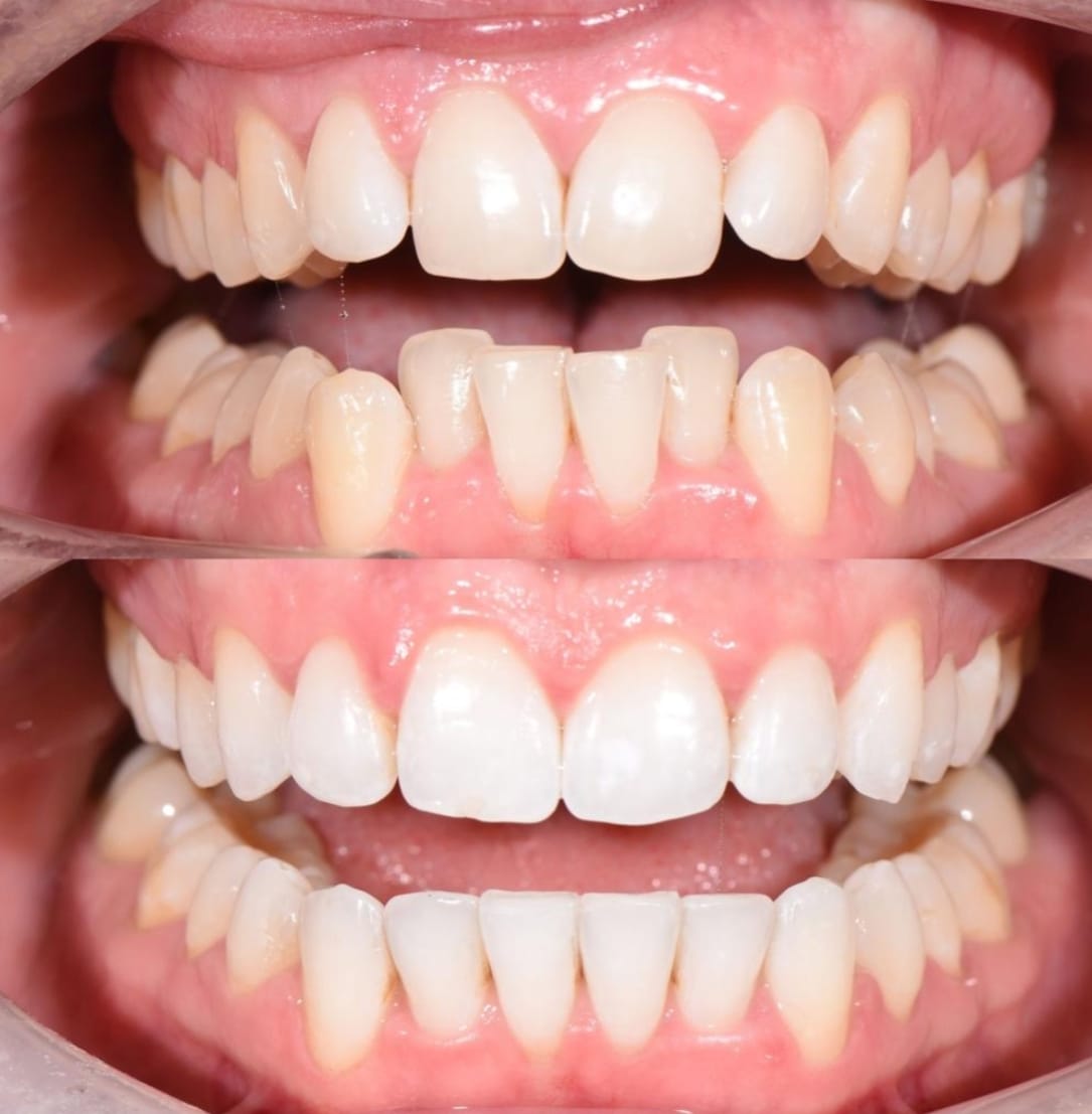 Clear Aligners Side View